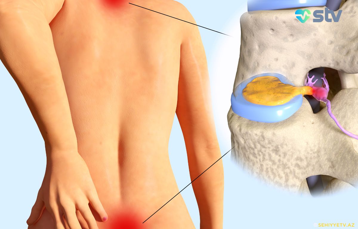 herniated disc disease - bel yırtığı səhiyyə xəbərləri