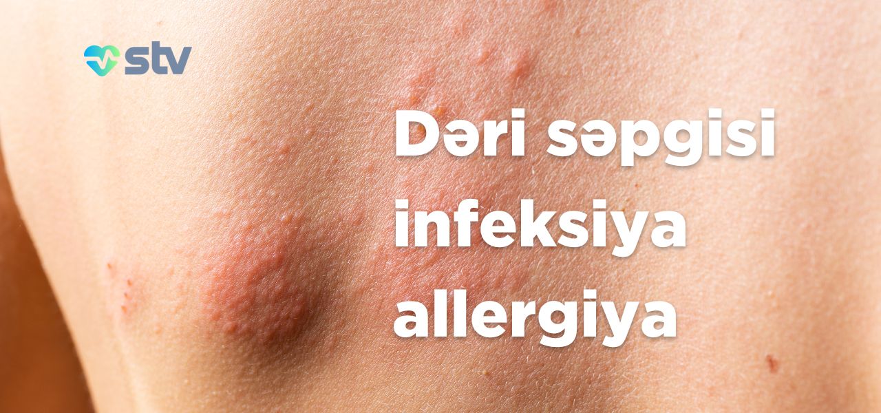 deri sepkisi infeksiya qasinma infection allergy