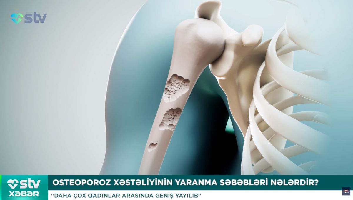 sumuk boslugu Osteoporozun (sümük əriməsi)